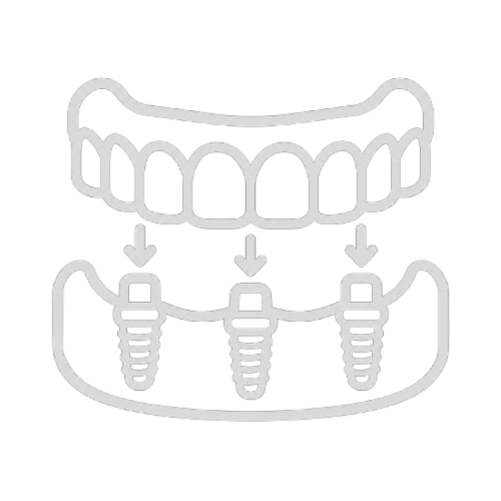 IMPLANT RETAINED DENTURES
